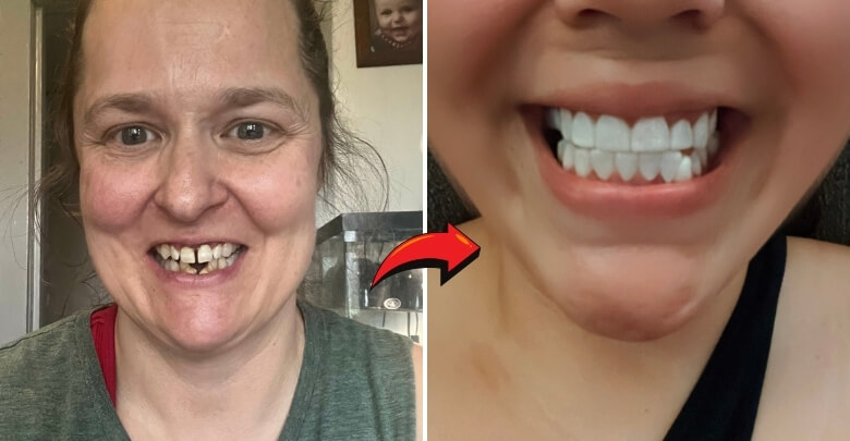 How Shiny Smile Veneers Work (Step-by-Step)