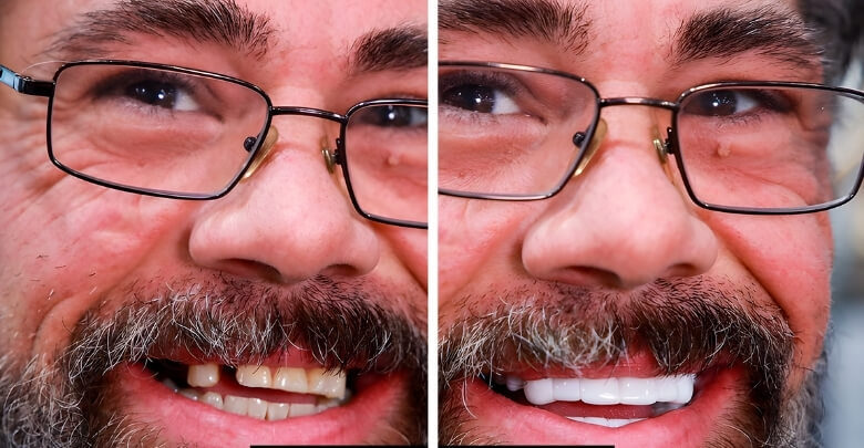 Eating With Removable Veneers vs. Permanent Dental Veneers