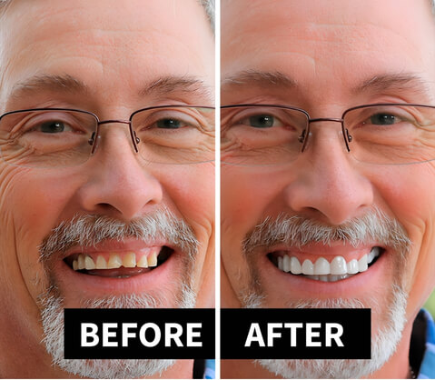 How Do Shiny Smile Veneers Actually Work